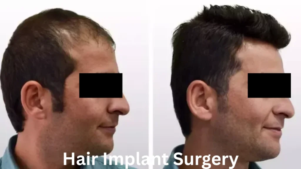 Hair Implant Surgery