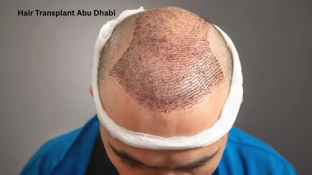 Hair Transplant Abu Dhabi