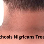 Acanthosis Nigricans Treatment