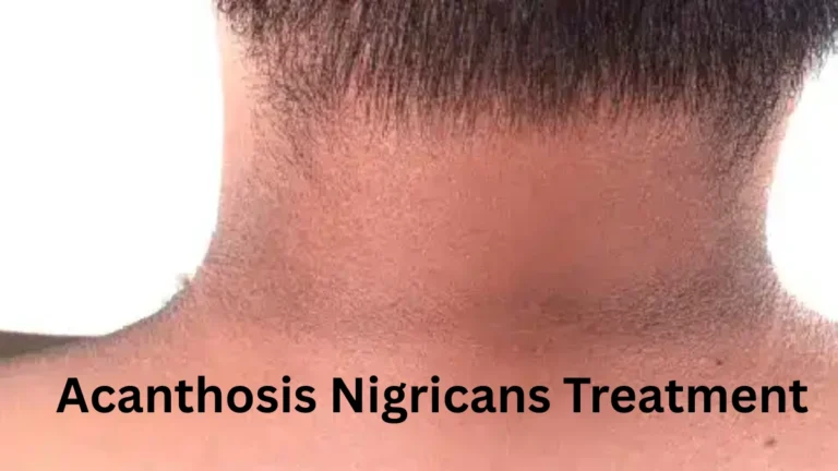 Acanthosis Nigricans Treatment