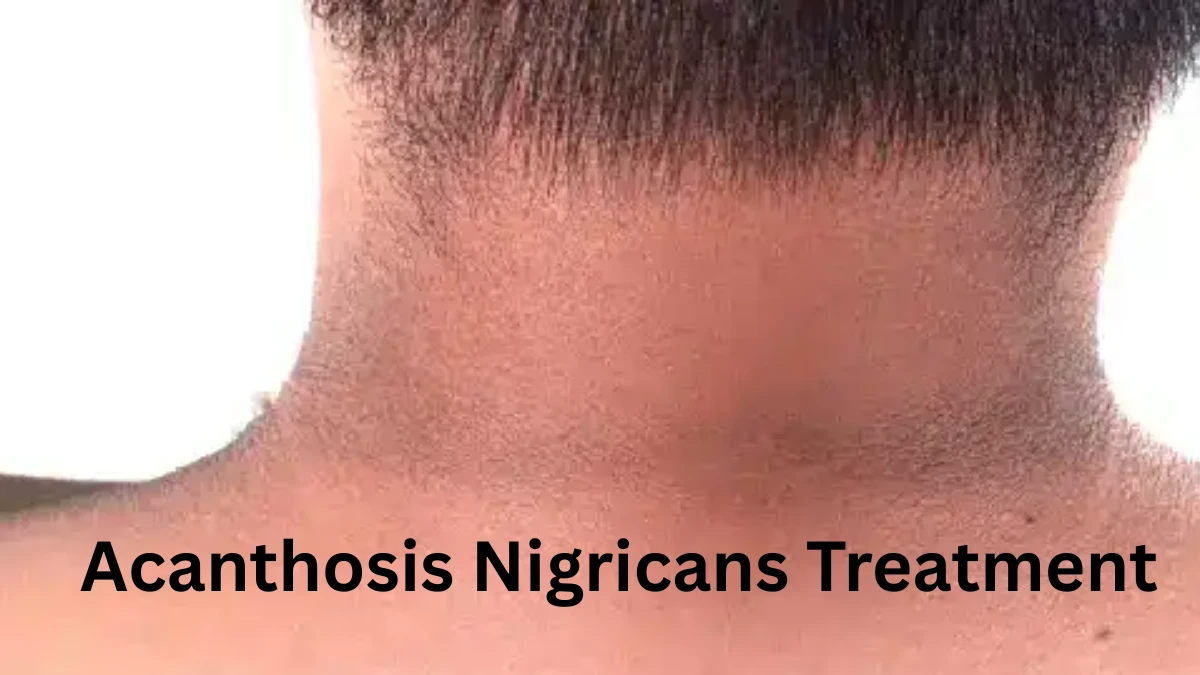 Acanthosis Nigricans Treatment