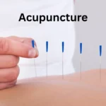 Acupuncture
