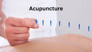 Acupuncture