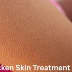Chicken Skin Treatment UAE