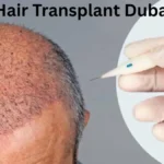 FUE Hair Transplant Dubai Cost