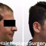 Hair Implant Surgery