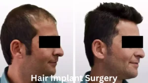 Hair Implant Surgery