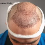 Hair Transplant Abu Dhabi