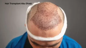 Hair Transplant Abu Dhabi