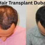 Hair Transplant Dubai