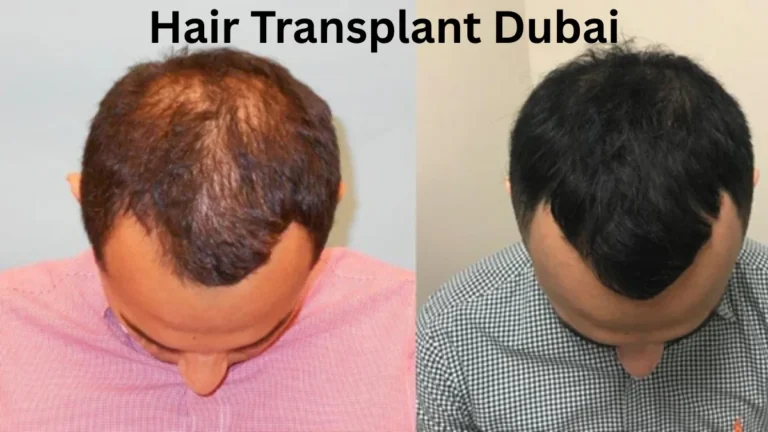 Hair Transplant Dubai