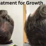Hair Treatment for Growth