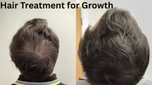 Hair Treatment for Growth