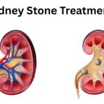 Kidney Stone Treatment