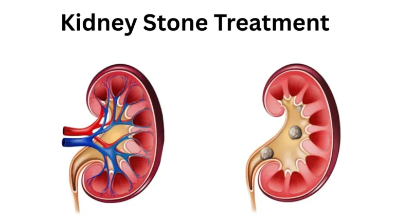 Kidney Stone Treatment