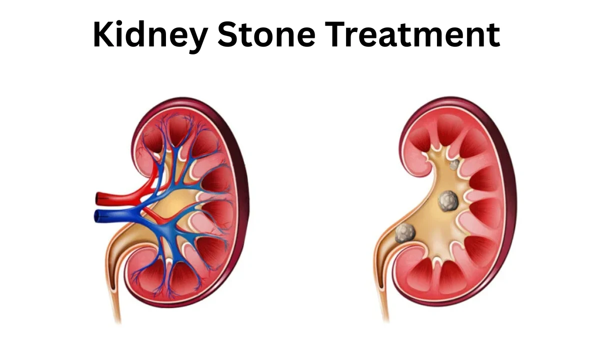 Kidney Stone Treatment