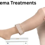 Lipedema Treatments