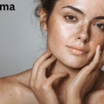 Melasma