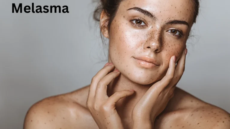 Melasma