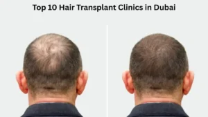 Top 10 Hair Transplant Clinics in Dubai