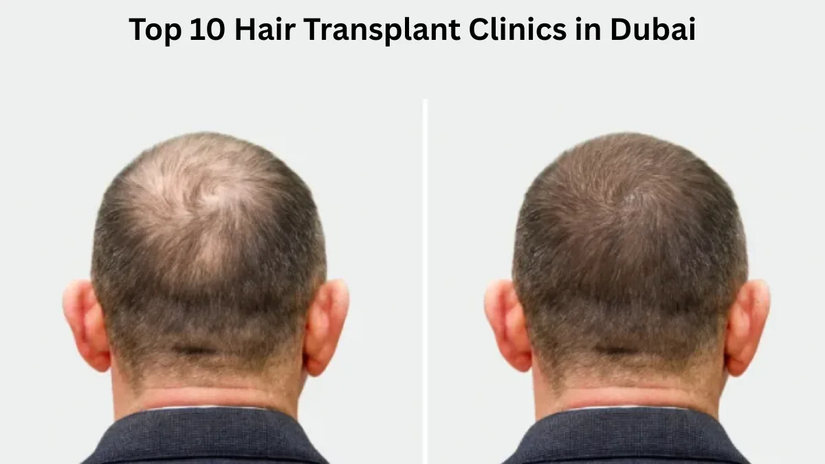 Top 10 Hair Transplant Clinics in Dubai